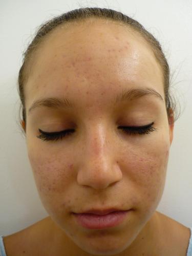 DermaCare Acne Treatment